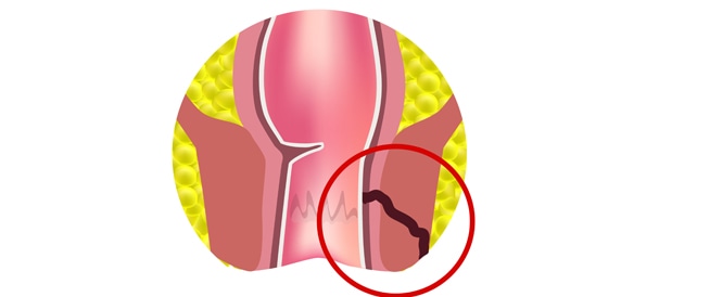 Fistula in anal opening: causes, symptoms and treatment