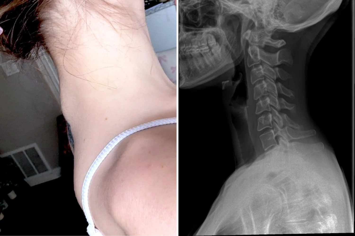 Gen Zer With Rare Condition Gets Botox Injected—Then Her Spine Destabilized – ryan