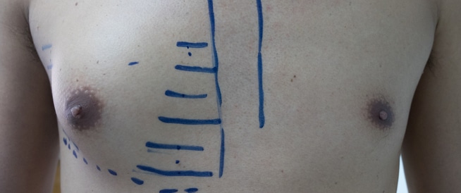 Breastwall crops: symptoms, causes and treatment
