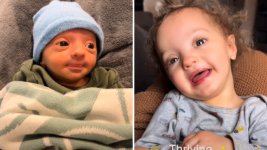 Mom Shares Baby Before and After Diagnosis With Rare Condition – ryan