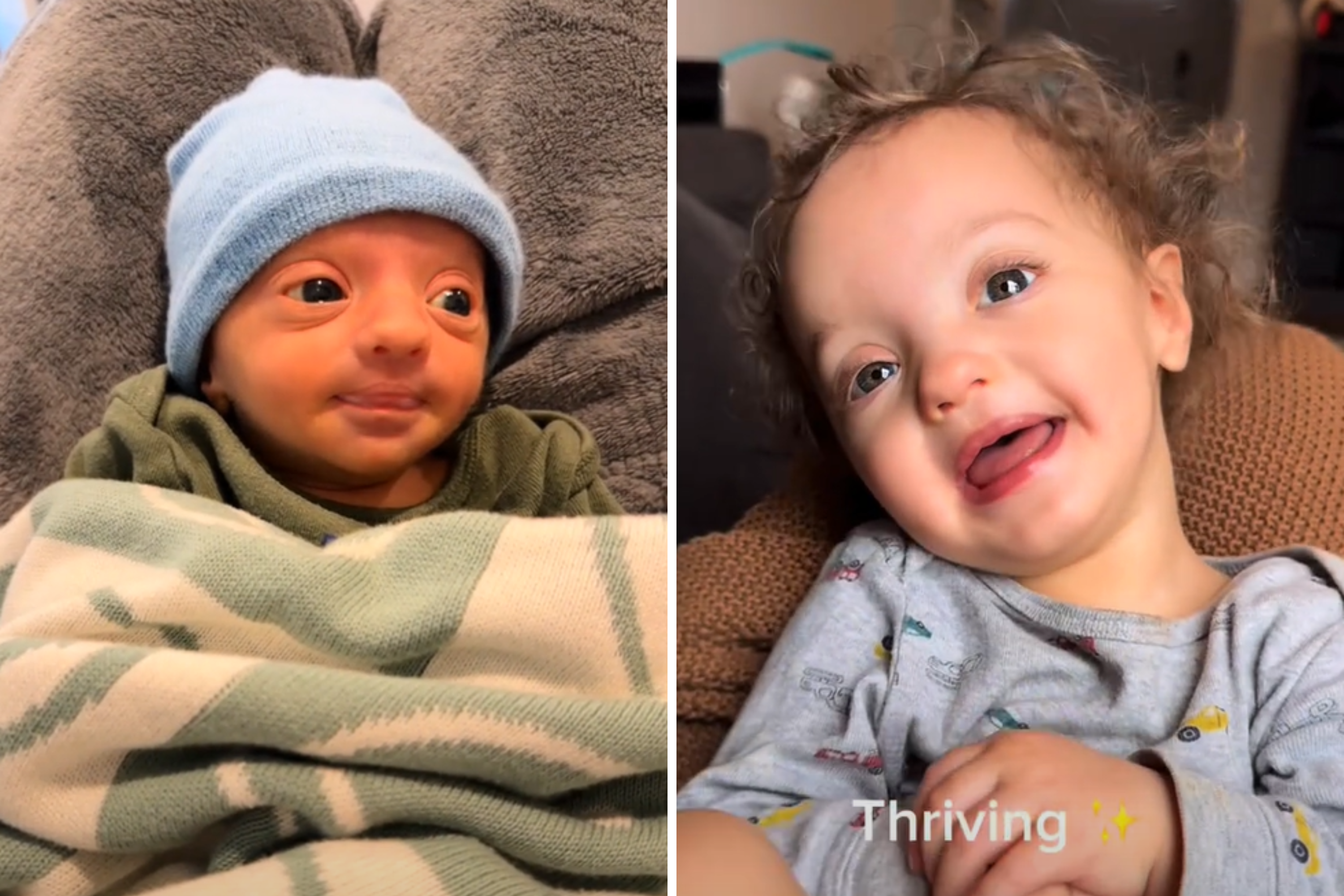 Mom Shares Baby Before and After Diagnosis With Rare Condition – ryan