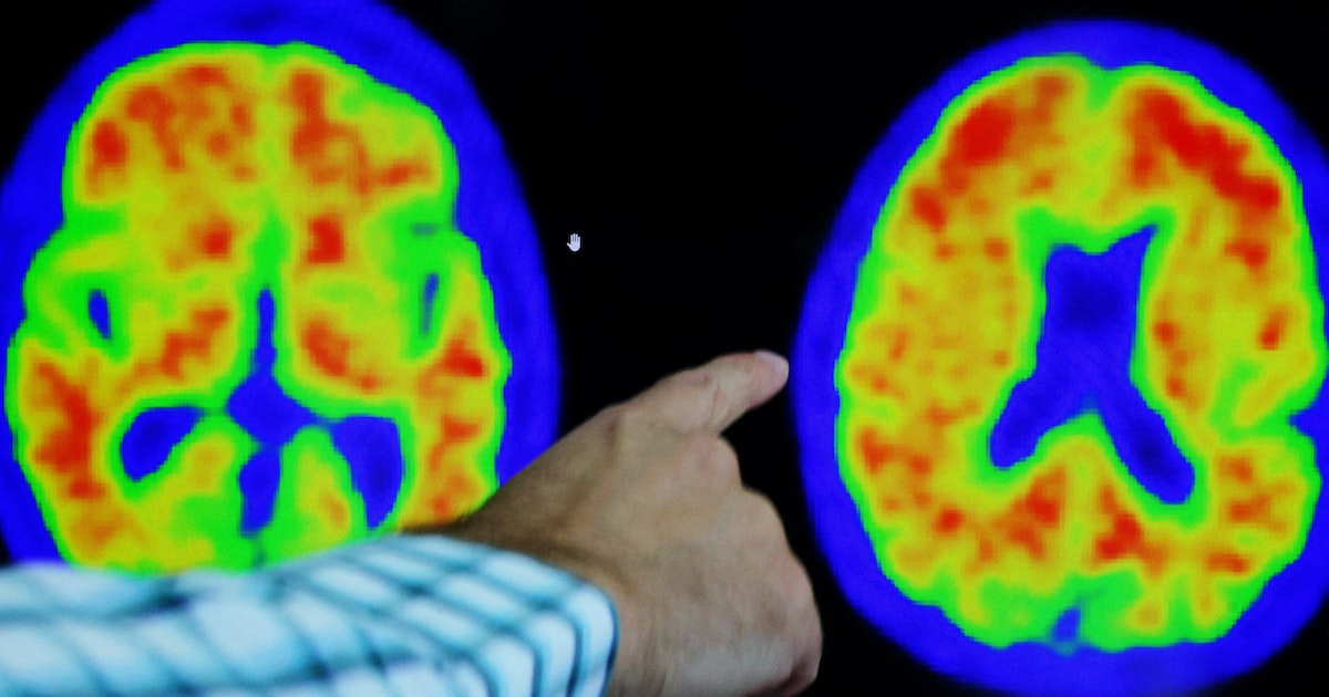 An American company tests a “slower cognitive decline” for Alzheimer’s patients