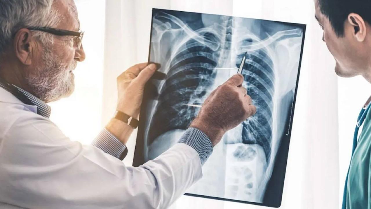 Eating habits increase the risk of lung cancer – ryan