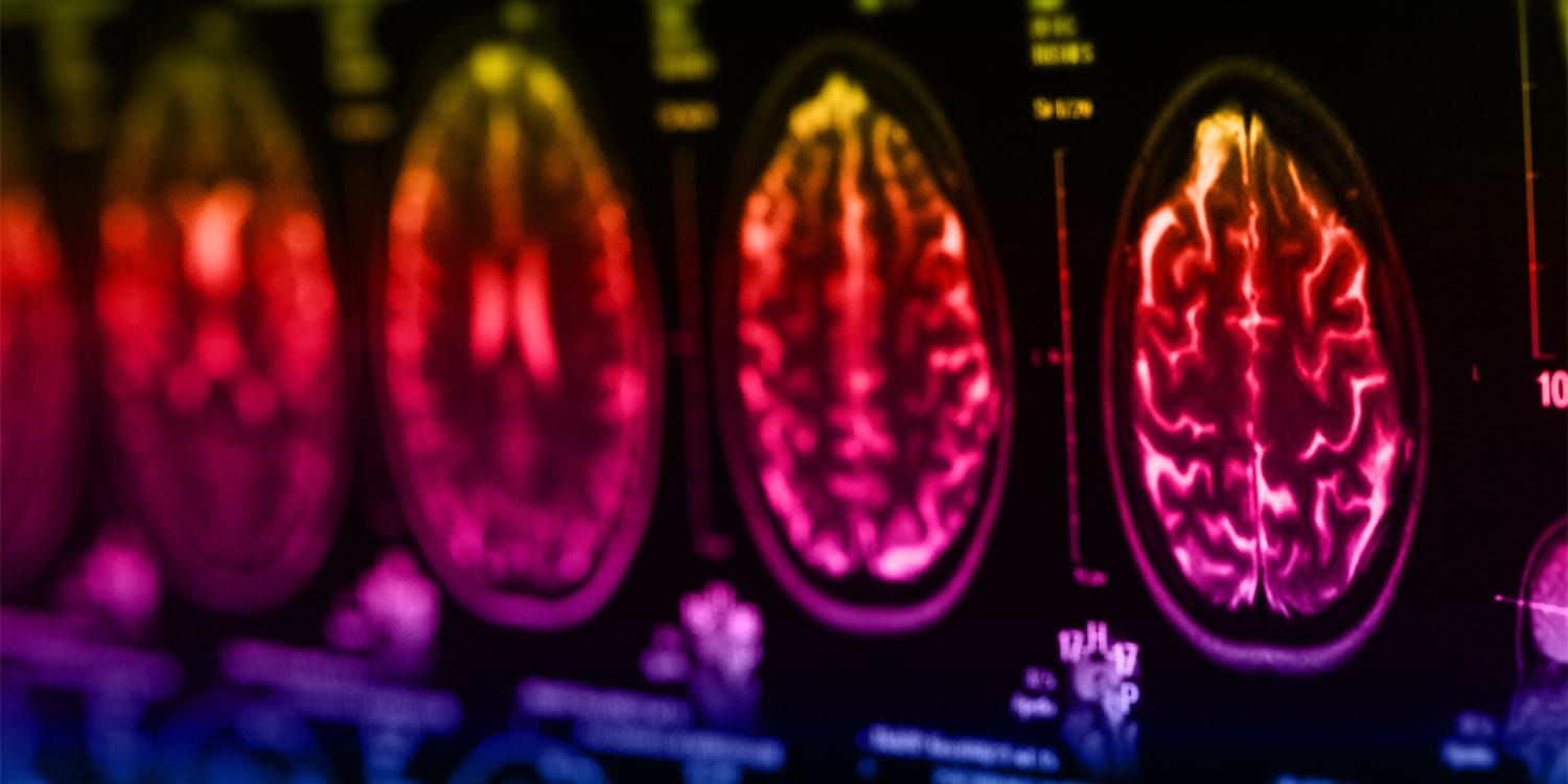 Youth With Traumatic Brain Injuries Show Higher Levels of Psychopathic Traits, New Study Finds – ryan
