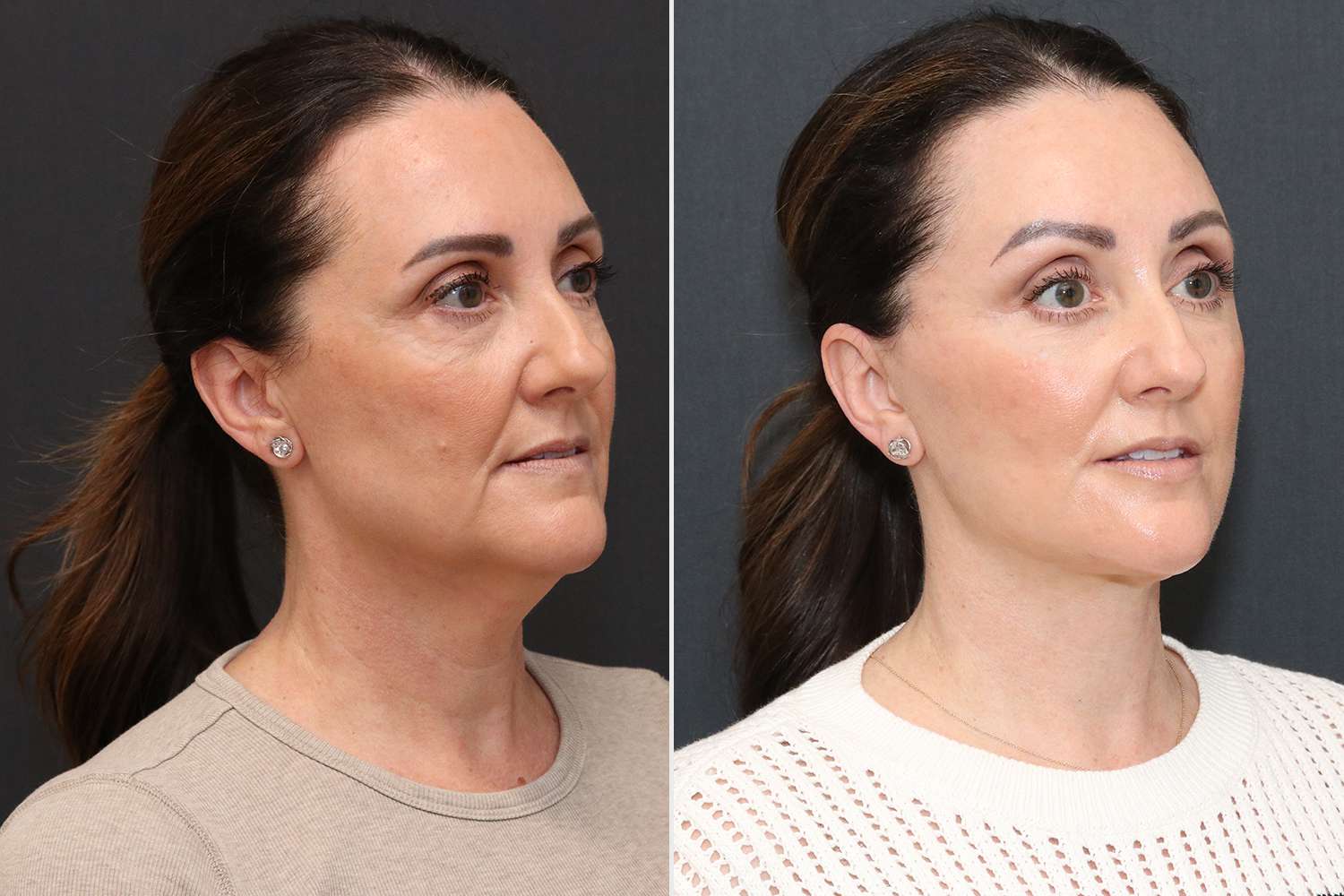Woman Describes Free Facelift, Live Surgery During Medical Training – ryan