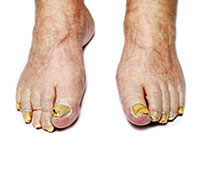 Fungi: Symptoms, causes and treatment.