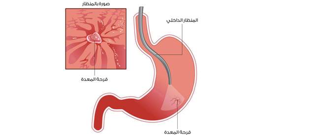 Stomach ulcer: Symptoms, Causes and Treatment