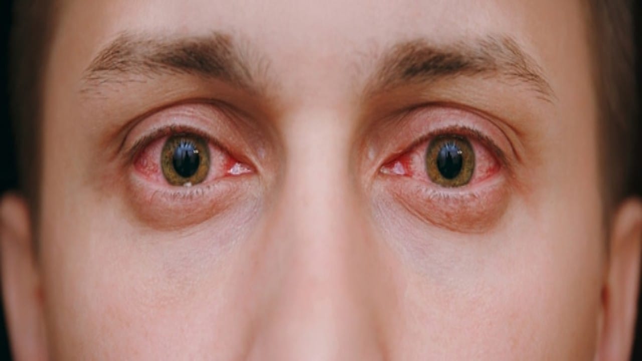 Spring ophthalmia attacks the eye in the spring – ryan
