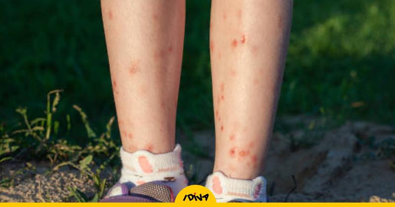 7 Effective Home Remedies To Get Rid Of Them – ryan