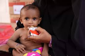 Malnutrition further increased the Yemen crisis, the anxiety of the NGO will be awful in the future