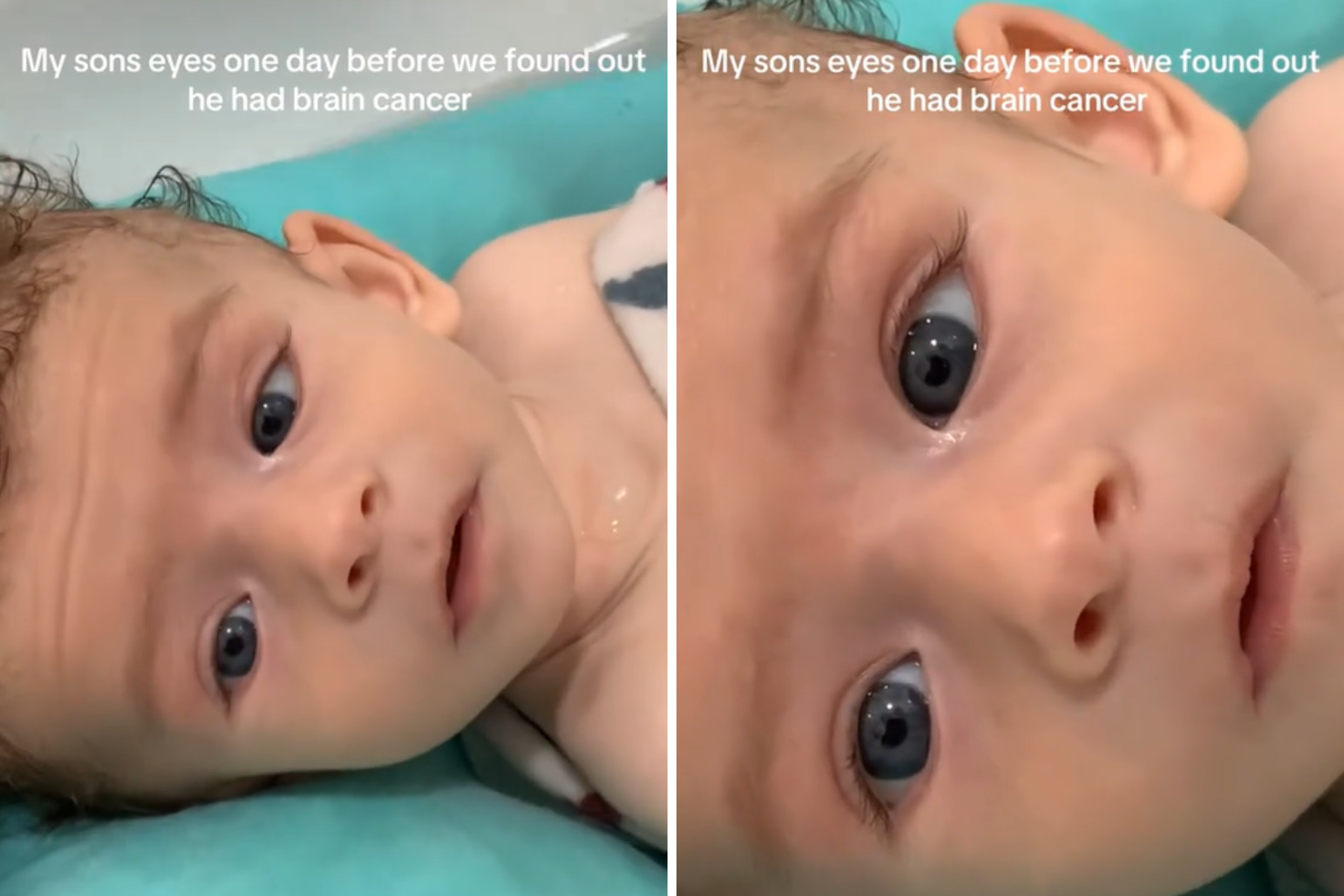 Mom Shares Baby’s Eyes One Day Before Brain Cancer Diagnosis – ryan