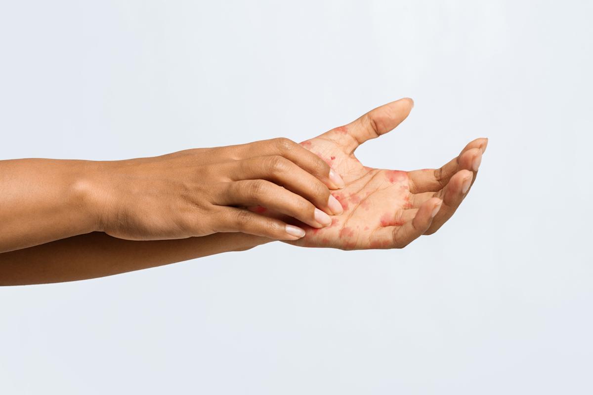 eczema-can-be-tugher-on-black-and-latinx-pores-and-skin-–-right-here’s-why