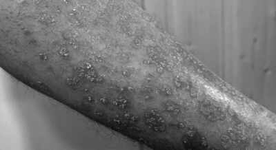 Skin cancer cases are rapidly increasing in older men over the past 30 years: Study