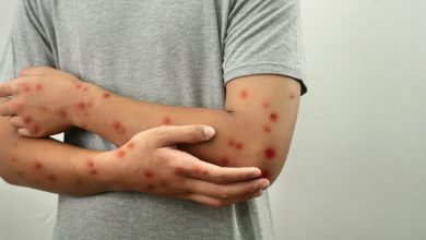 جهود محاصرة “بوحمرون” تقلّص معدل انتشاره بنسبة 80 في المائة – ryan