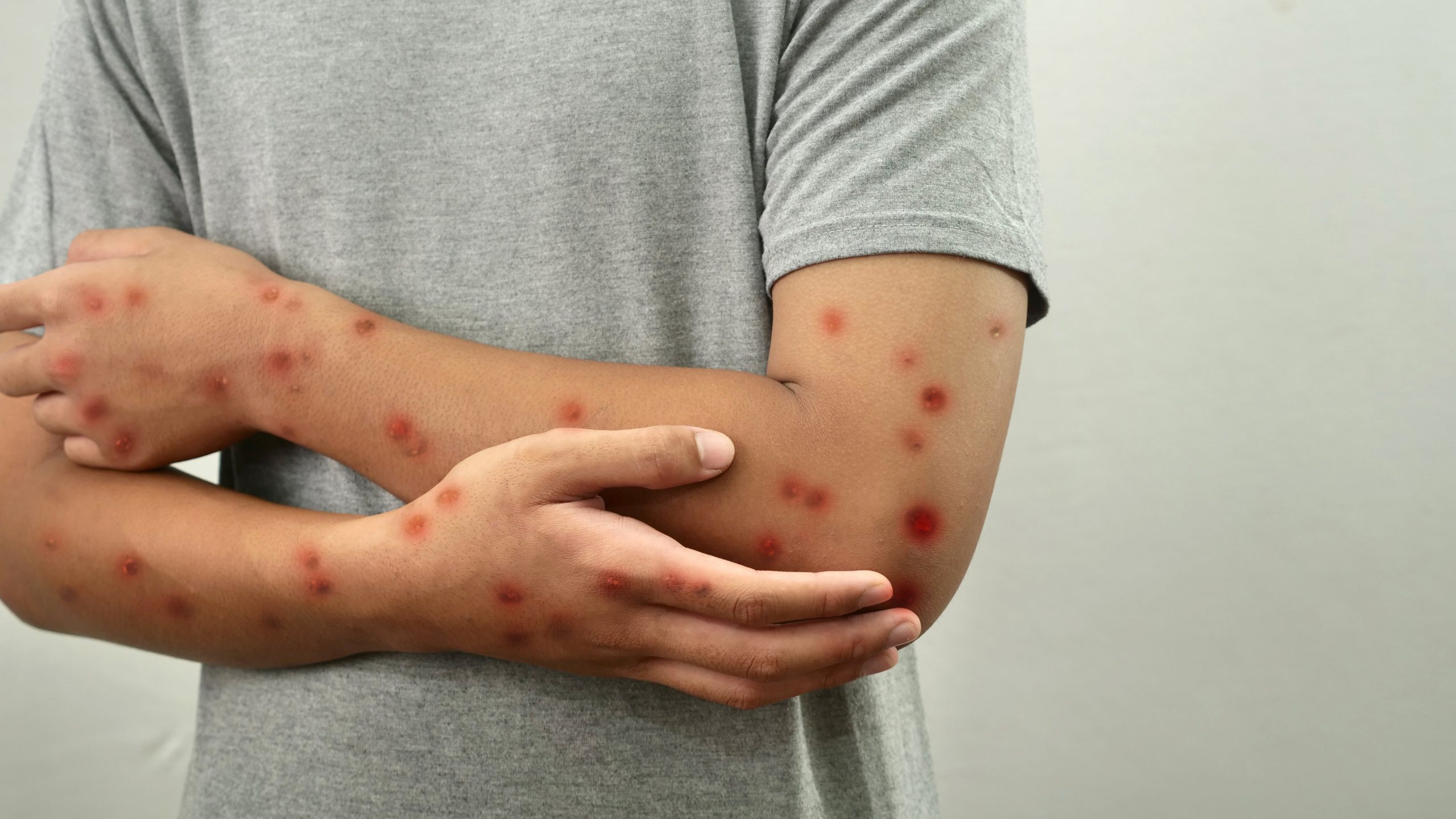 جهود محاصرة “بوحمرون” تقلّص معدل انتشاره بنسبة 80 في المائة – ryan