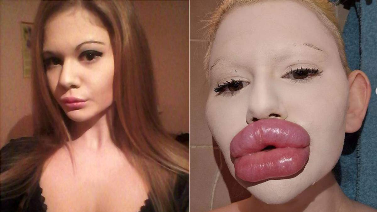 This woman underwent lip surgery to look beautiful, then she would be shocked to know what happened