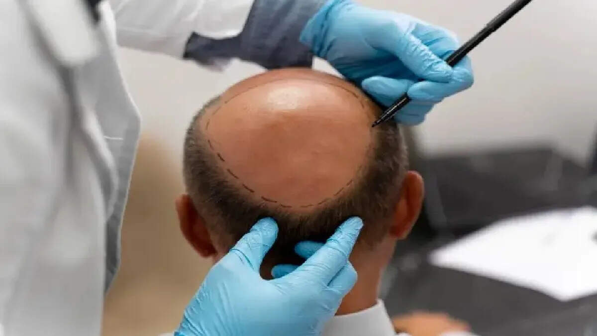 Two engineers died after the alleged wrong hair transplant in the Kanpur clinic