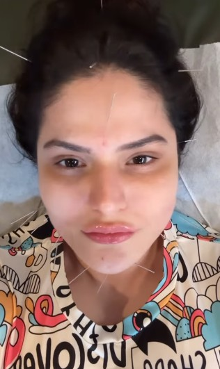 Facial acupuncture: small ‘needle’ is a solution to many problems with the increasing glow of the face