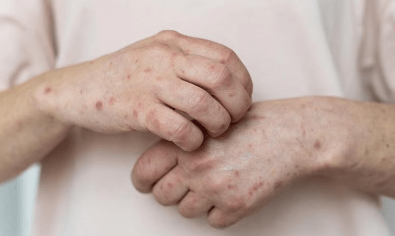 الفلبين-تسجل-10-إصابات-وتُفعّل-الطوارئ-الصحية-في-كوتاباتو