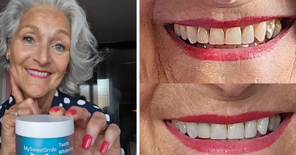 teeth-whitening-kit-that-made-a-77-ear-op’s-smile-‘discover-unprecedented’-is-20%-off