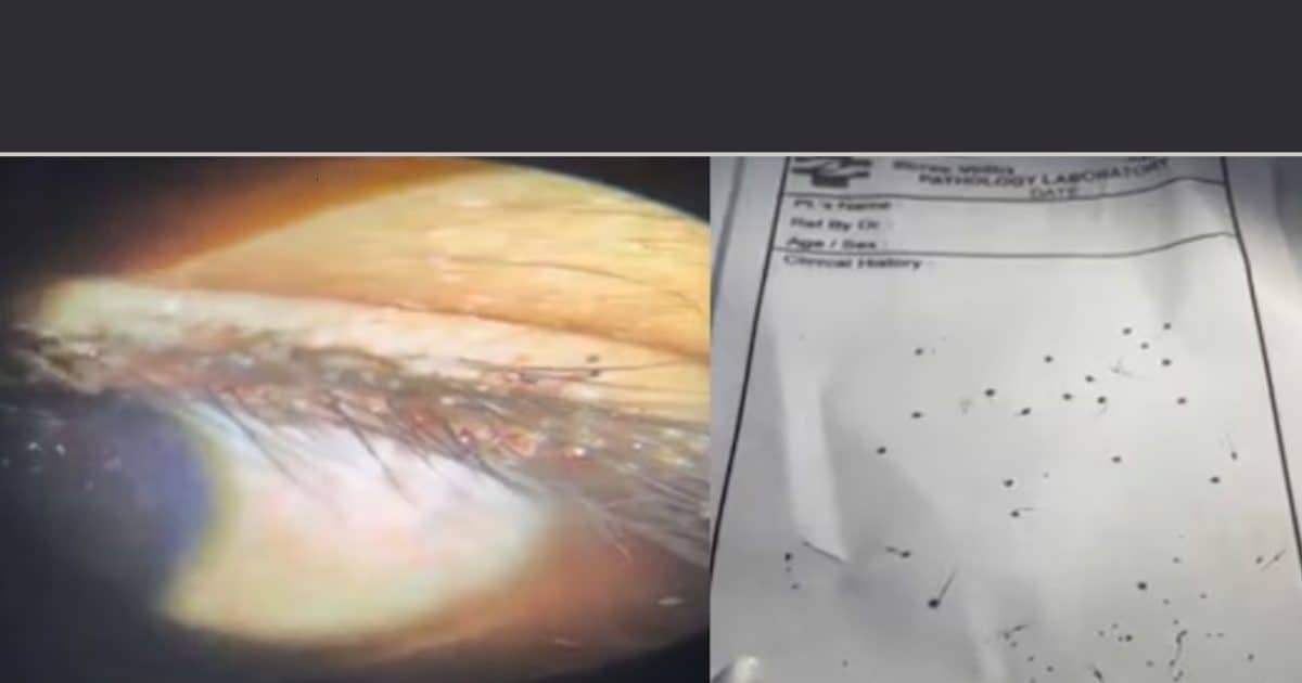 30 Insects and 35 eggs found in the eyelid of an 8-year-old child: How are you?