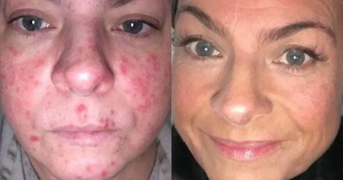 non-greasy-spf-that’s-‘anti-blemish’-give-clearer-pores-and-skin-and-‘extra-confidence’