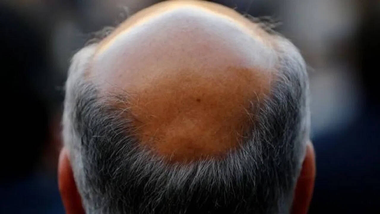 Brother -in -in’s brother’s brother -in -law, the ‘hair’ of the head is uprooted