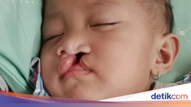 Toddler Khalisa needs another 3 split lip surgery, let us help