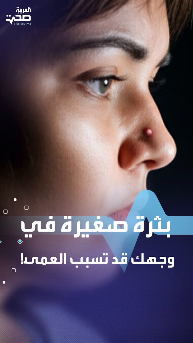 بثرة صغيرة في وجهك بمنطقة “مثلث الموت” قد تسبب إصابتك بالعمى! صحة _صحة