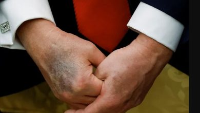 كدمات متكررة على يد ترامب تثير الجدل.. والبيت الأبيض يعلق