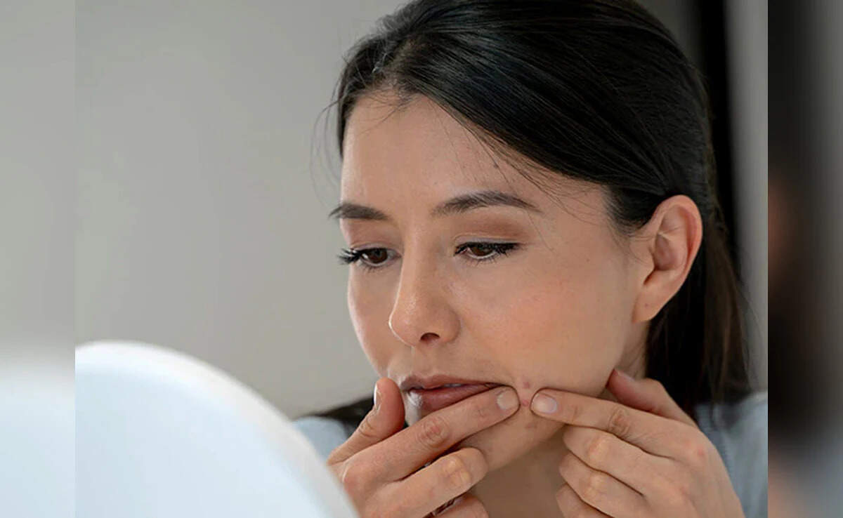 Glie and pimple -free skin without spending money will disappear within a few days