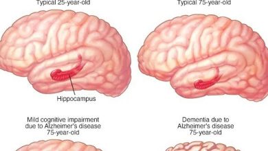 Moderate cognitive imbalance (MCI) .. Causes and methods of prevention and treatment