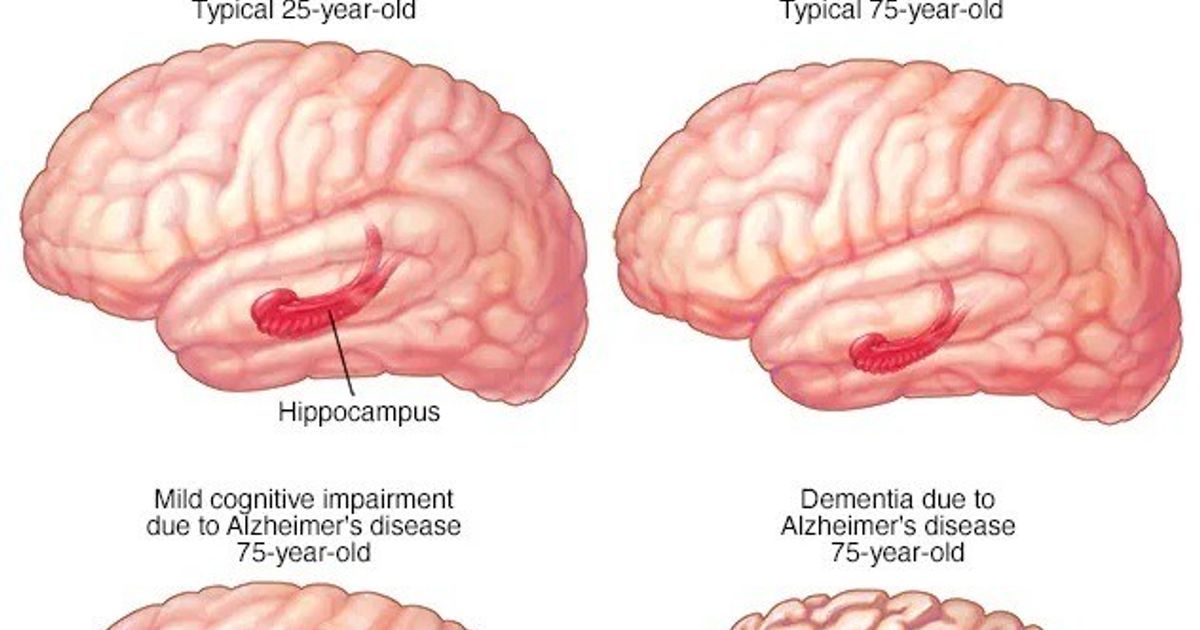Moderate cognitive imbalance (MCI) .. Causes and methods of prevention and treatment