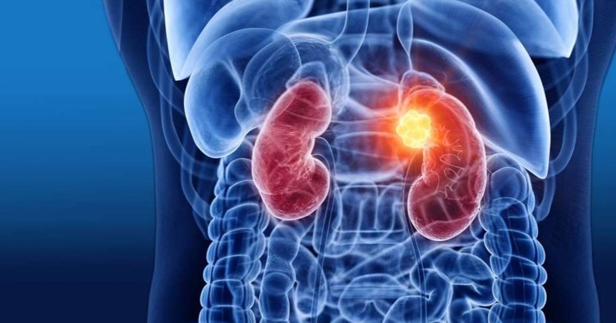 Researchers develop ‘ready’ immune treatment for any patient with kidney cancer