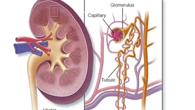 Causes of acute kidney infection and how to avoid it