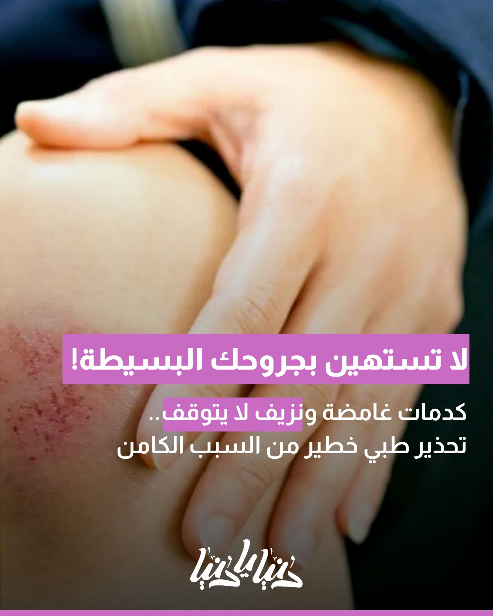 كدمات غامضة ونزيف لا يتوقف.. قد تكون علامة على اللوكيميا