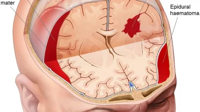 Coacher brain injuries … shocks or accidents lead to chronic complications