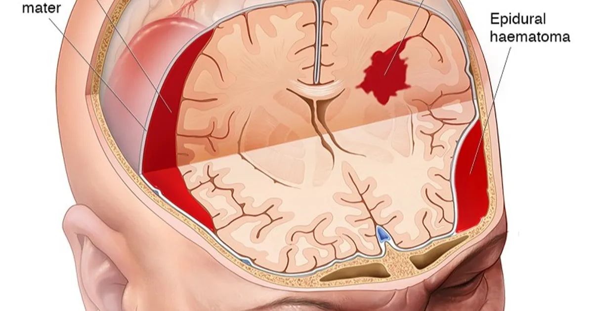 Coacher brain injuries … shocks or accidents lead to chronic complications