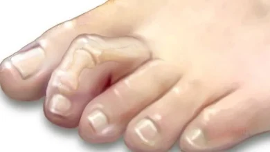 Break the tone .. 4 treatment methods and 6 weeks to recover