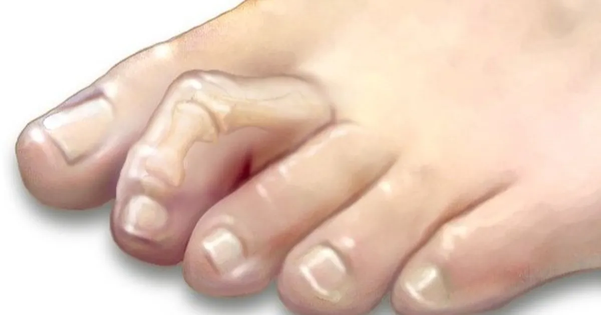 Break the tone .. 4 treatment methods and 6 weeks to recover