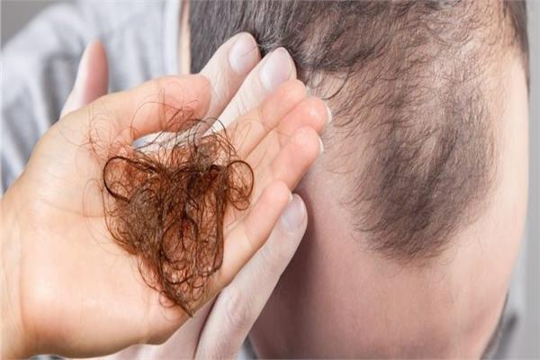 دراسة تكشف: المشروبات الغازية تُسقط الشعر