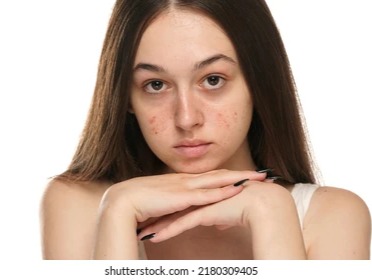 Dry and dark skin will be clean in chutika