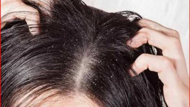3 houses will get rid of dry scalp, the difference will be seen in a few days