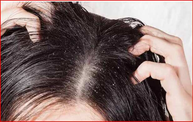 3 houses will get rid of dry scalp, the difference will be seen in a few days