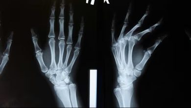 فريق صيني يطور “غراء عظمي” باسم Bone-02 يثبت الكسور خلال 3 دقائق.. مستوحى من التصاق المحار…
