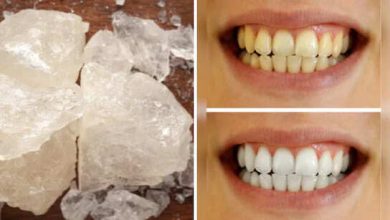 How to clean with alun, yellow plaque stored on teeth? This recipe will shine like beads