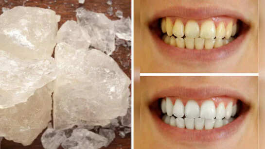 How to clean with alun, yellow plaque stored on teeth? This recipe will shine like beads