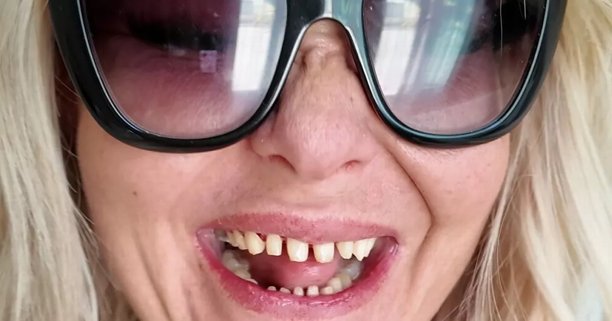 ‘I Started One Habit to Avoid Drinking Too Much and It Cost with My Teeth’ – ryan