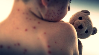 Namibia’s north-western region issued the government guidelines in the grip of measles