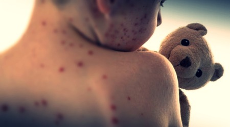 Namibia’s north-western region issued the government guidelines in the grip of measles